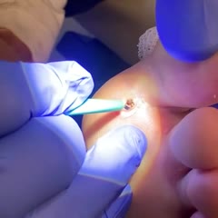 Splinter in the foot